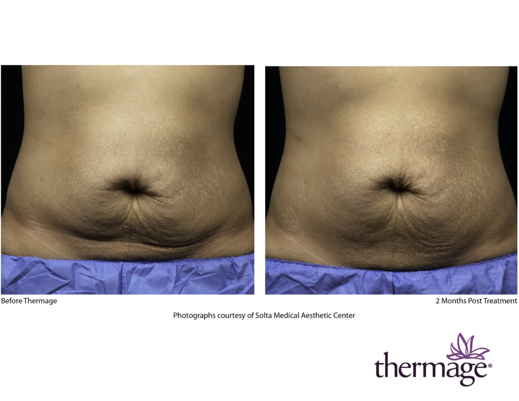 thermage before after smac 01