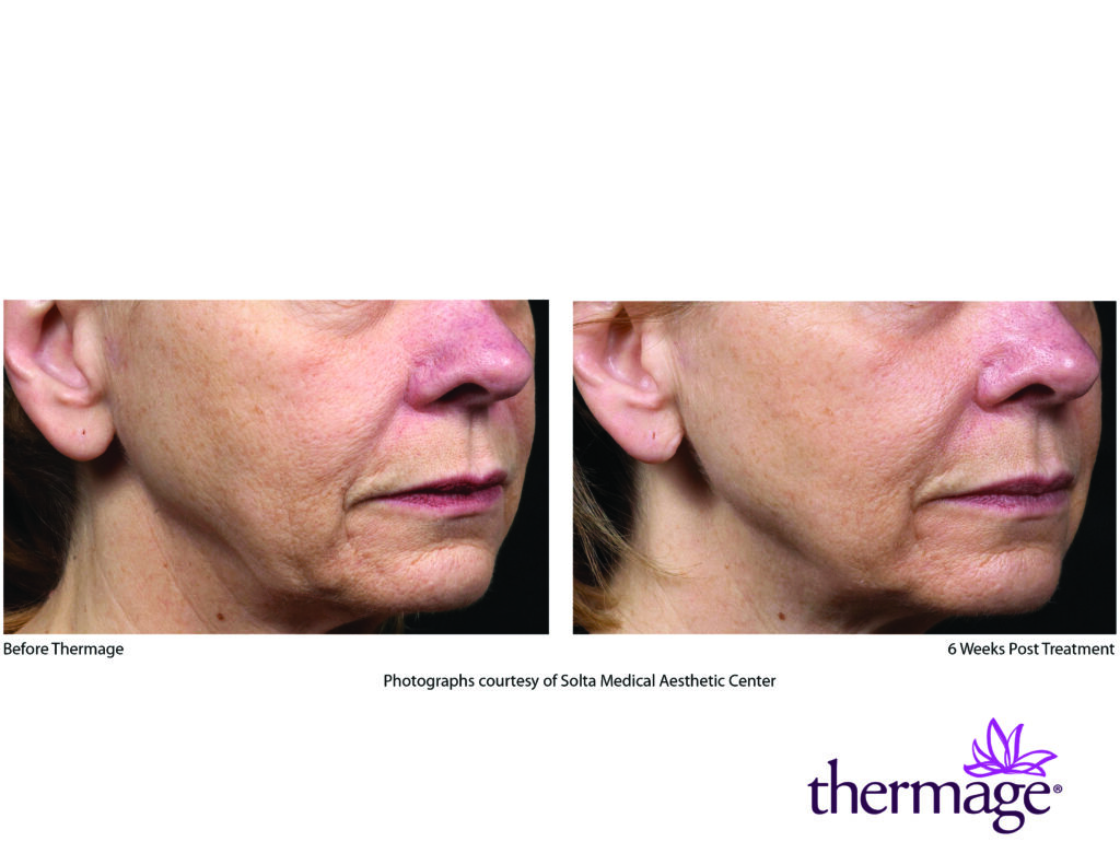 thermage before after smac 02