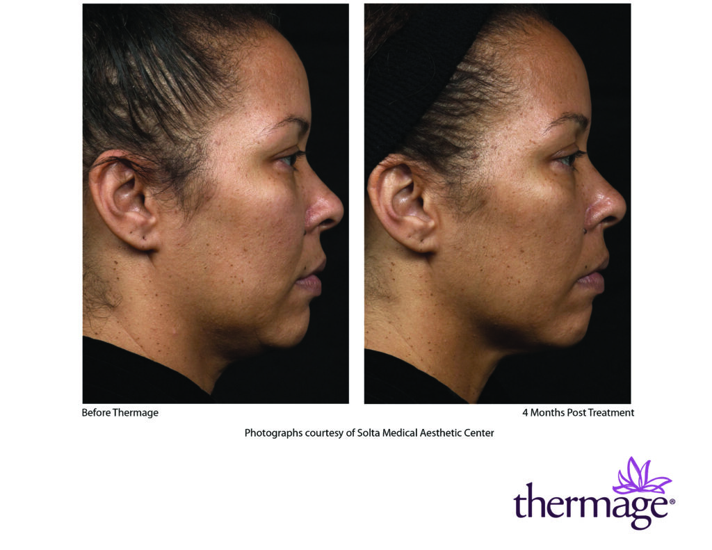 thermage before after smac 04
