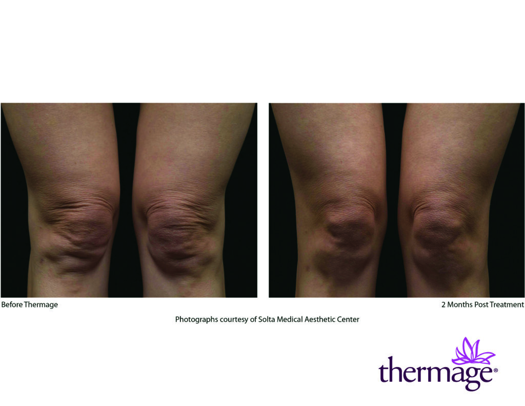 thermage before after smac 06