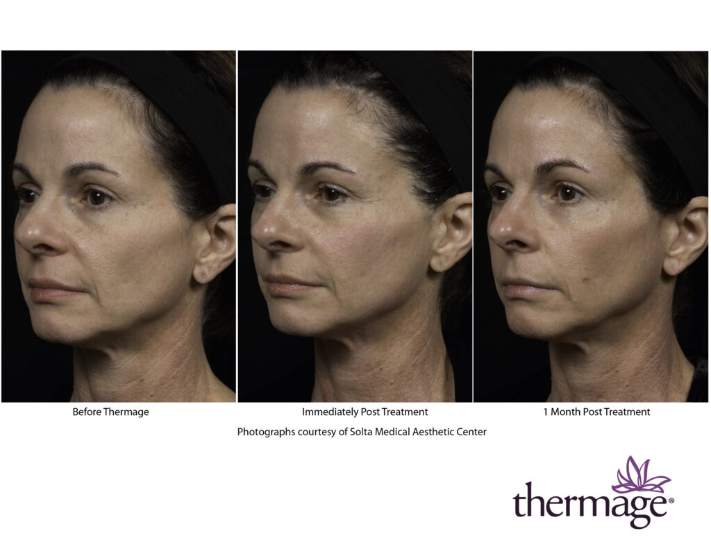 thermage before after smac 08