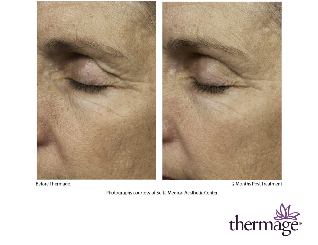 thermage before after smac 10