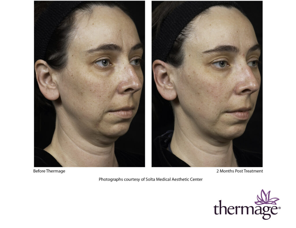 thermage before after smac 11