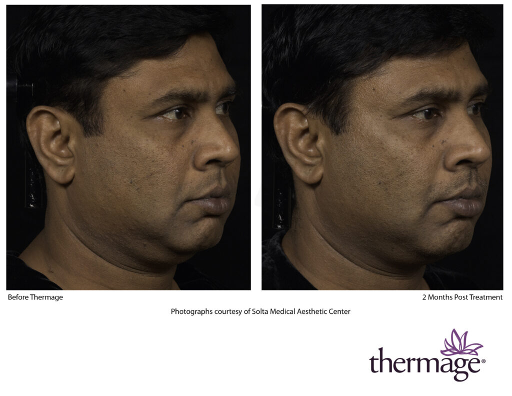 thermage before after smac 12