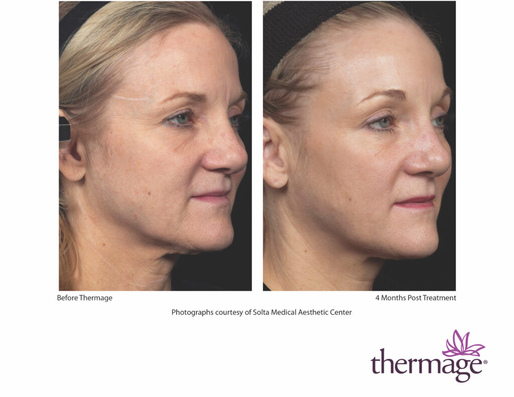 thermage before after smac 14