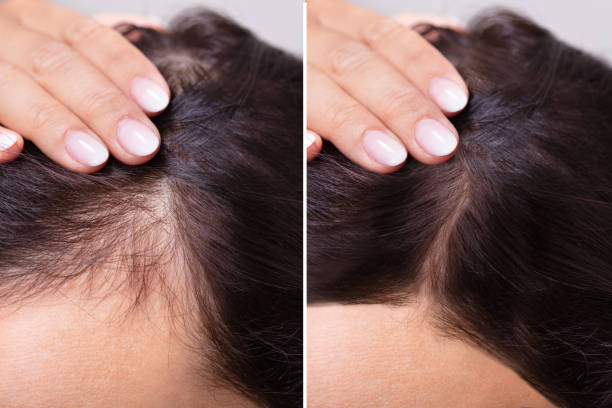 woman before and after hair loss treatment
