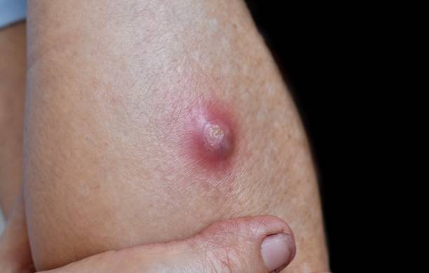 large carbuncle or abscess at forearm of asian burmese male patient.